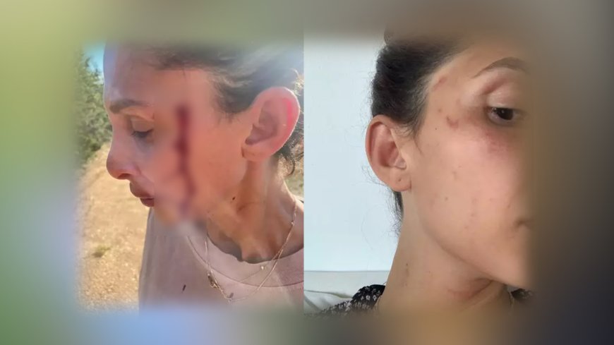 Can Yaman’ın Sevgilisi Sara Bluma’dan Kanlar İçinde Şok Paylaşım: “Şiddet Görüyorum”