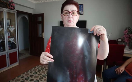 Kayseri’de 22 Yıllık Ameliyat İğnesi Şaşkına Çevirdi: “Canlı Bomba Gibi Geziyorum”