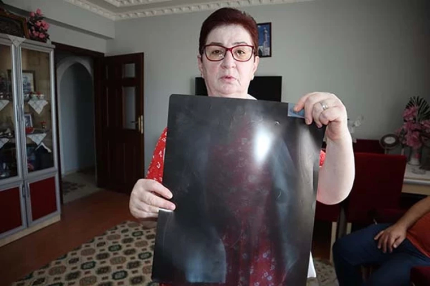 Kayseri’de 22 Yıllık Ameliyat İğnesi Şaşkına Çevirdi: “Canlı Bomba Gibi Geziyorum”