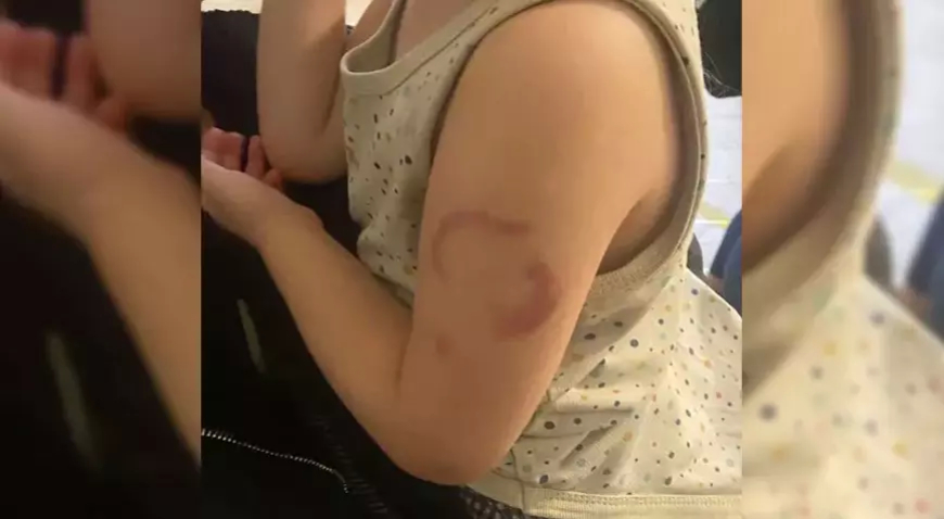 Edirne’de Özel Kreşte “Isırılma” İddiası: Baba Şikayetçi Oldu