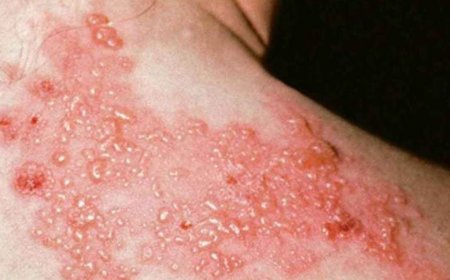 Zona Riski 50 Yaş Sonrası Artıyor: Erken Tanı ve Tedavi Hayati