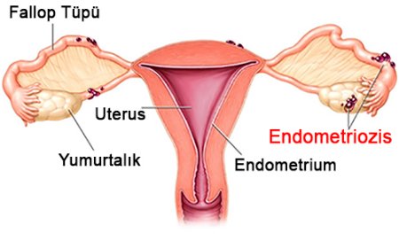 Uzmanından uyarı: Endometriozis kısırlığa neden olabiliyor