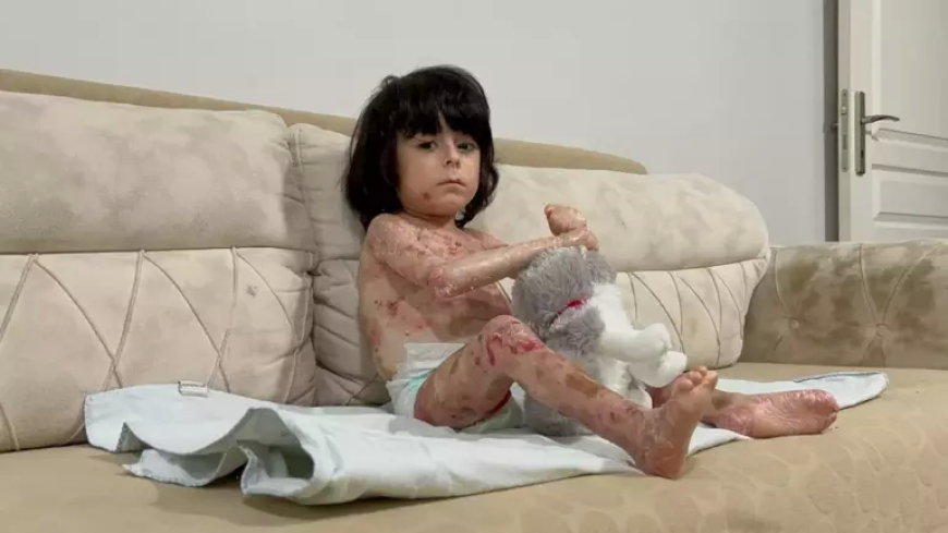 4 Yaşındaki İbrahim, ‘Kelebek Hastalığı’ ile Mücadele Ediyor: Yardım Eli Bekliyor