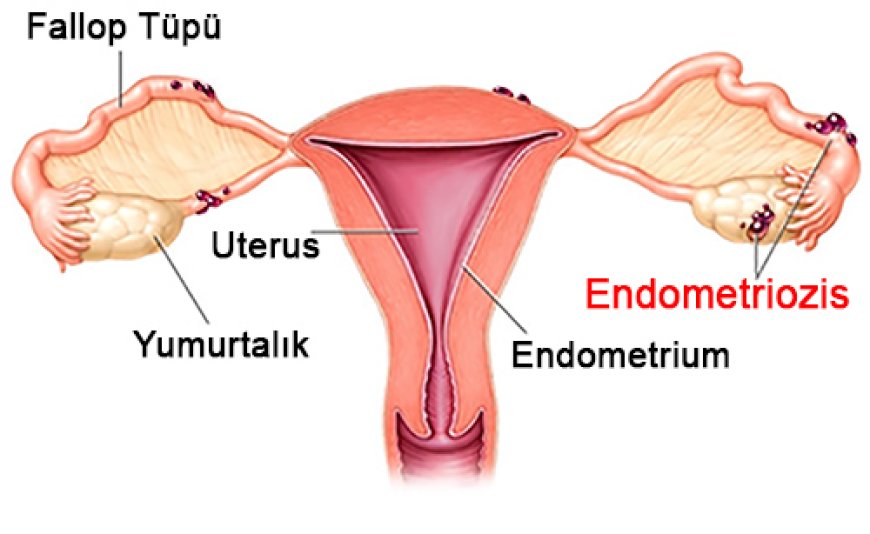 Uzmanından uyarı: Endometriozis kısırlığa neden olabiliyor