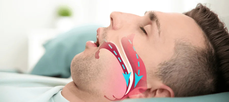 Uyku Apnesinde Yeni Bir Umut: İlaçlı Tedavi Yolda