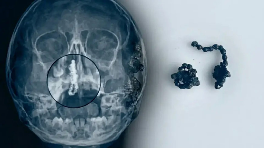 Rize’de Tıp Dünyasını Şoke Eden Olay: 5 Yaşındaki Polen’in Burnundan Çıkanlar 'Pes' Dedirtti!