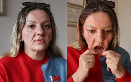 Diş Ağrısıyla Gitti, Hayatı Karardı: 25 Dişinden Oldu, 36 Çeyrek Altın Harcadı