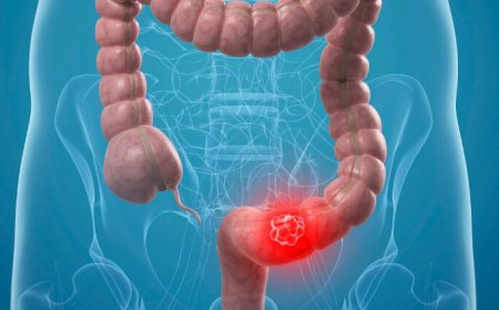 Genç Yaşta Görülme Oranı Artıyor: Kolon Kanserinde "Gençlik" Yanılgısı