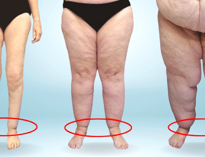 "Gitmeyen Kilo" Değil, Doğrudan Hastalık: Lipödem!