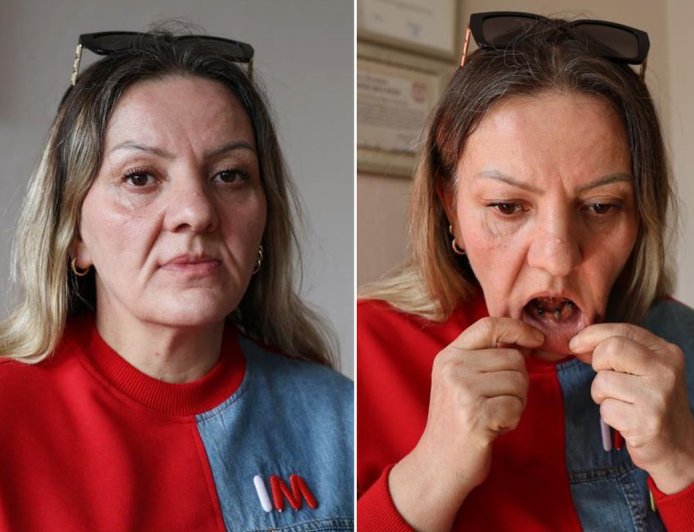 Diş Ağrısıyla Gitti, Hayatı Karardı: 25 Dişinden Oldu, 36 Çeyrek Altın Harcadı