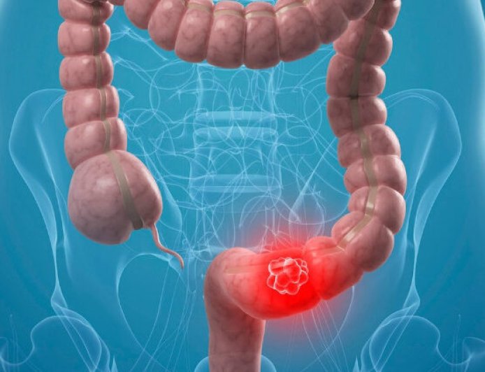 Genç Yaşta Görülme Oranı Artıyor: Kolon Kanserinde "Gençlik" Yanılgısı