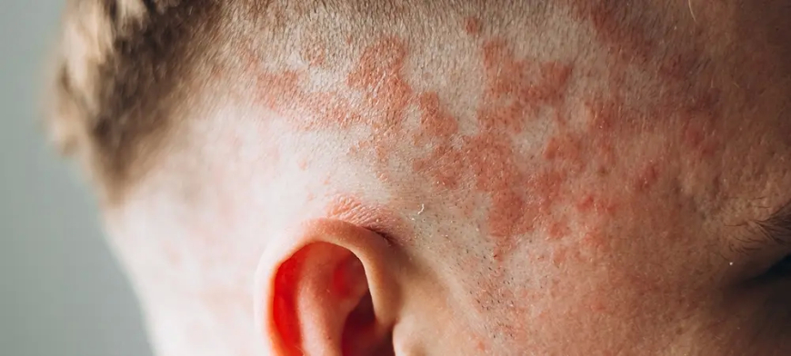 Ailelerin "Diyet" Yanılgısı Egzamalı Çocuklarda Alerji Riskini Artırıyor!