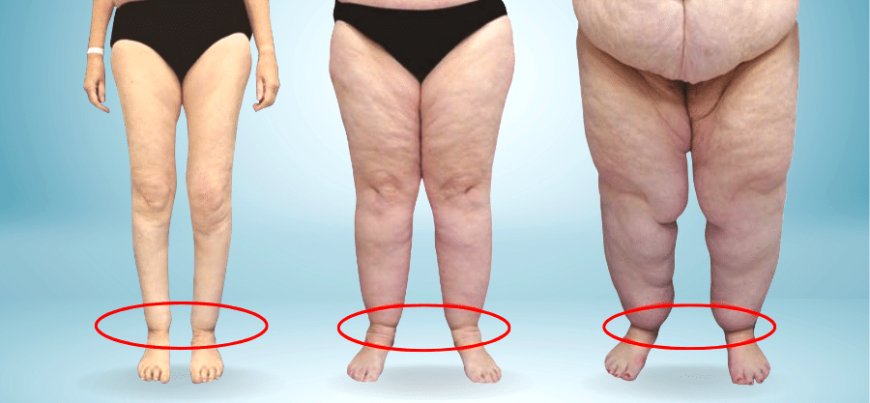 "Gitmeyen Kilo" Değil, Doğrudan Hastalık: Lipödem!
