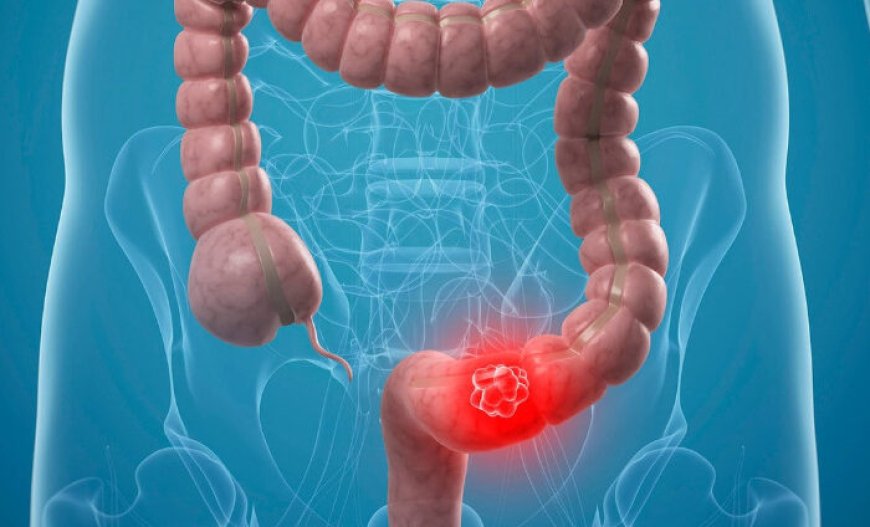 Genç Yaşta Görülme Oranı Artıyor: Kolon Kanserinde "Gençlik" Yanılgısı